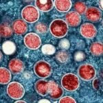 Cacar Monyet di Amerika Serikat dan Seluruh Dunia: Situasi Saat Ini