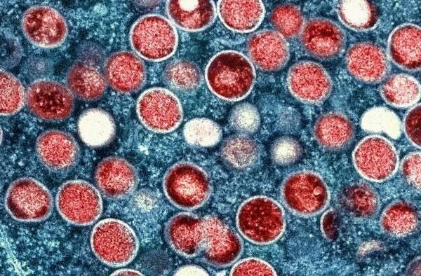 Cacar Monyet di Amerika Serikat dan Seluruh Dunia: Situasi Saat Ini